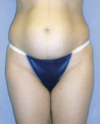 Tummy Tuck Before