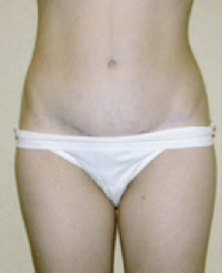 Tummy Tuck After