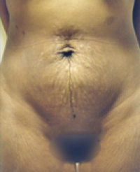 Tummy Tuck Before