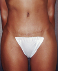 Tummy Tuck After