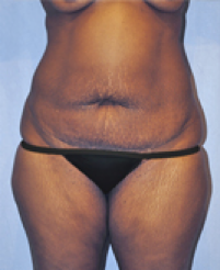 Tummy Tuck Before