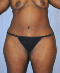 Tummy Tuck After