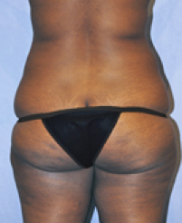 Tummy Tuck Before