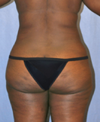 Tummy Tuck After