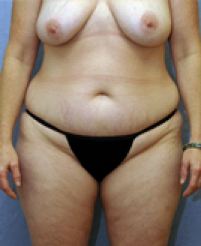 Tummy Tuck Before