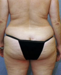 Tummy Tuck Before