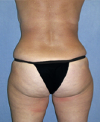 Tummy Tuck After