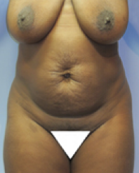 Tummy Tuck Before