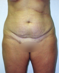 Tummy Tuck Before