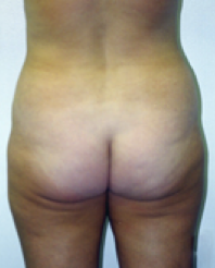 Tummy Tuck Before