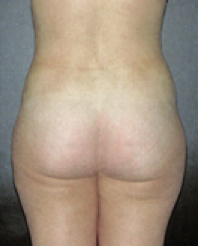 Tummy Tuck After