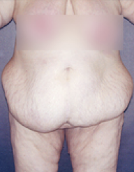 Tummy Tuck Before