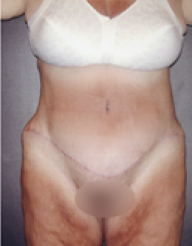 Tummy Tuck After