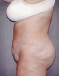 Tummy Tuck After