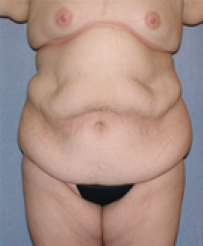 Tummy Tuck Before