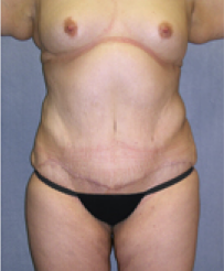 Tummy Tuck After