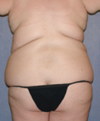 Tummy Tuck Before