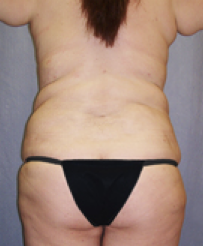 Tummy Tuck After