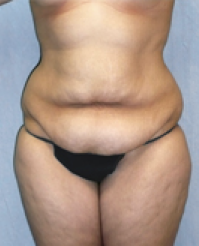 Tummy Tuck Before