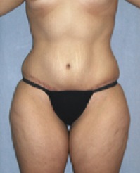 Tummy Tuck After