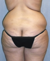 Tummy Tuck Before