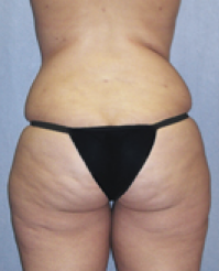 Tummy Tuck After