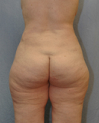 Tummy Tuck After