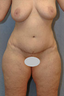 Tummy Tuck Before