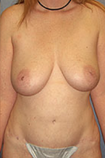 Tummy Tuck After