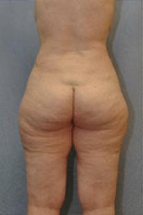 Tummy Tuck Before