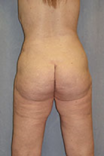 Tummy Tuck After