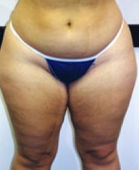 Liposuction Before