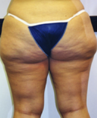 Liposuction Before