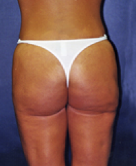 Liposuction After