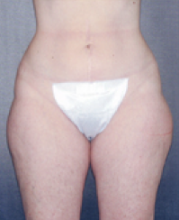 Liposuction Before