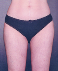 Liposuction After