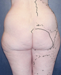 Liposuction Before