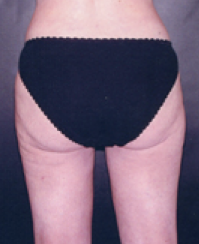 Liposuction After