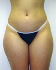 Liposuction Before