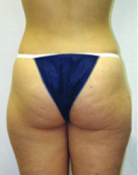 Liposuction Before