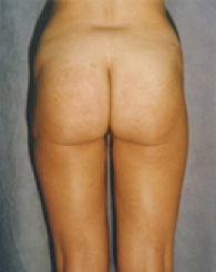 Liposuction After