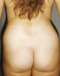 Liposuction Before