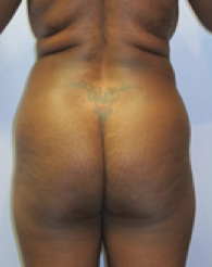 Liposuction Before