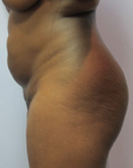 Liposuction Before