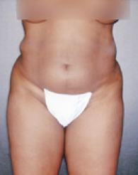 Liposuction Before