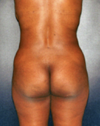 Liposuction After