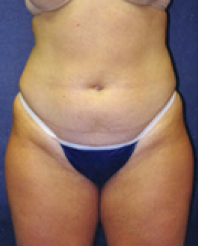 Liposuction Before