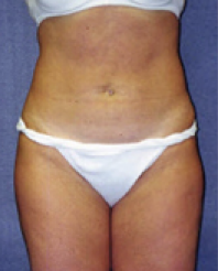 Liposuction After