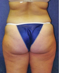 Liposuction Before