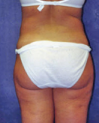 Liposuction After